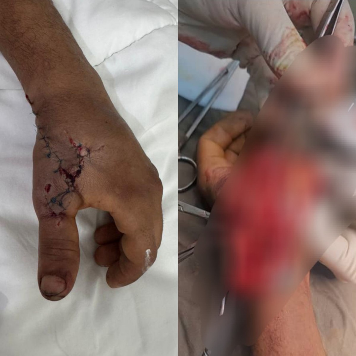 Adani surgical staff saves the hand of a young man who suffered a very serious injury