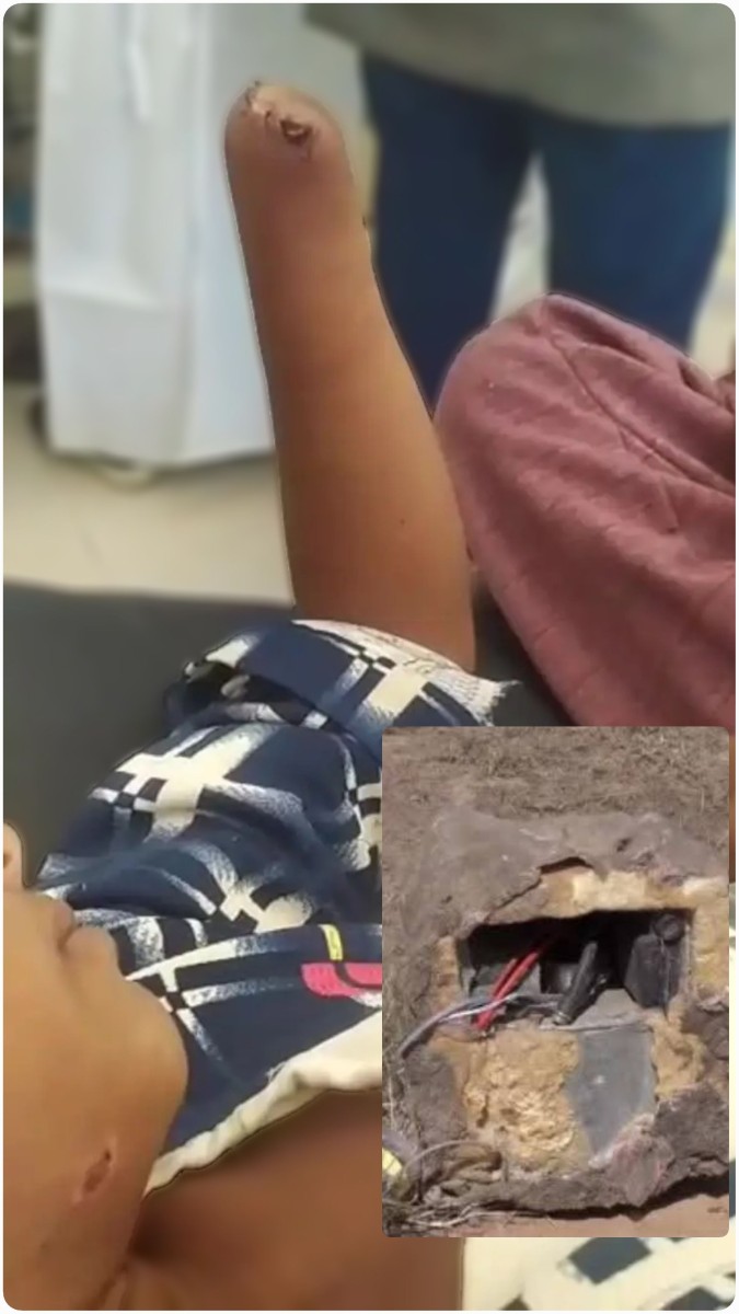 A camouflaged Houthi device causes the amputation of a child's hand in Hajjah
