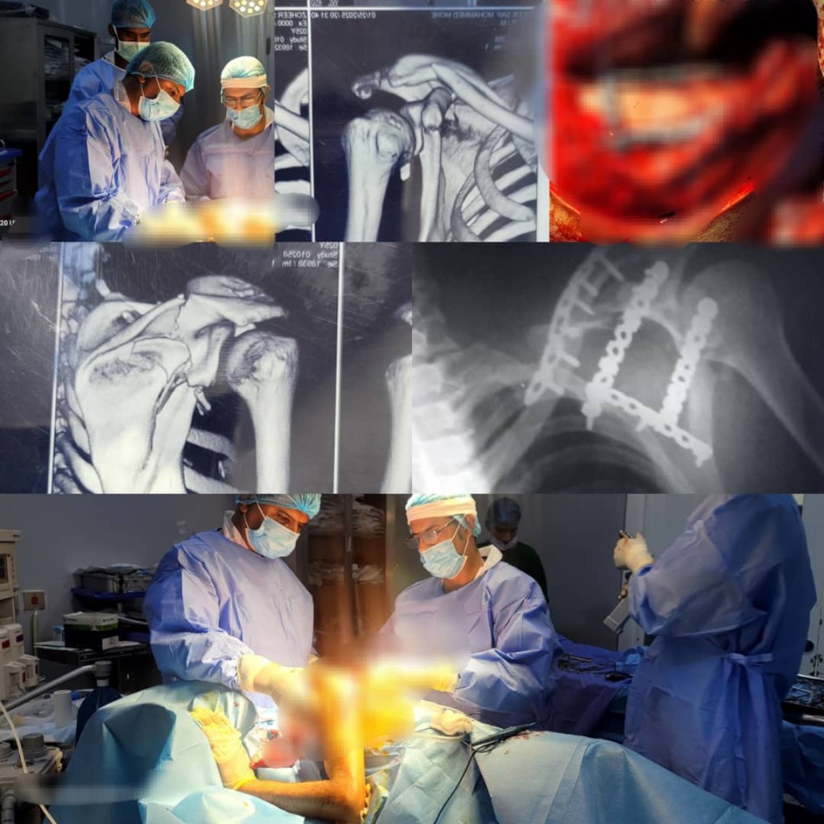 Dr. Adel Al -Hajj succeeds in performing a rare surgery in Abboud Military Hospital in Aden