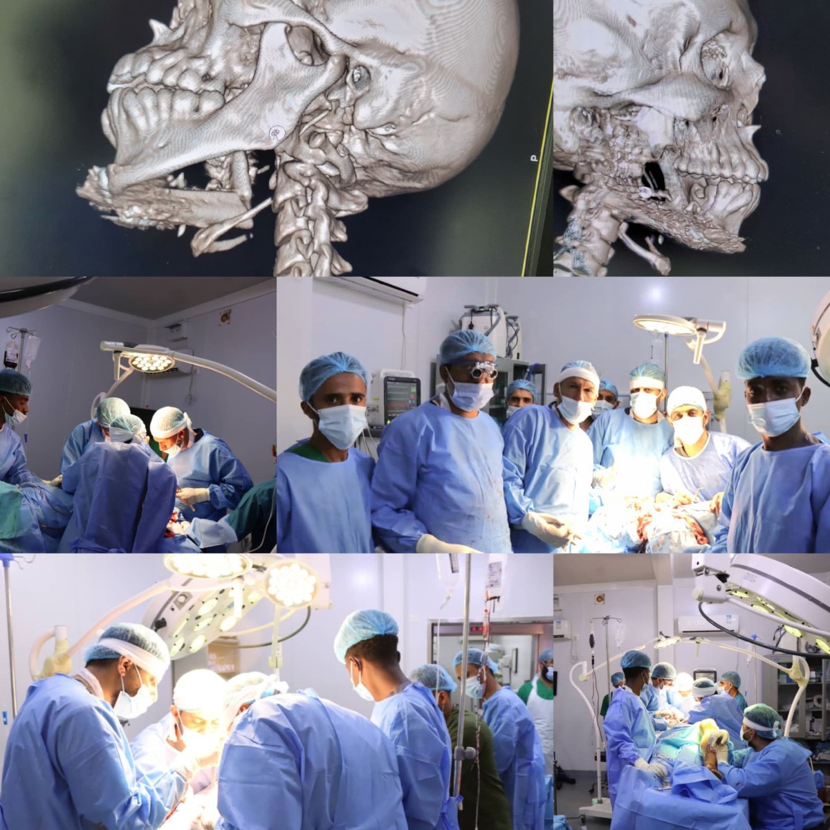 A medical team is performing a complex surgery to eradicate a tumor and rebuild the lower jaw of a patient patient