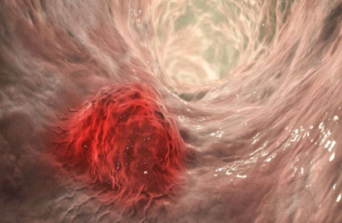 A common snack fights bowel cancer