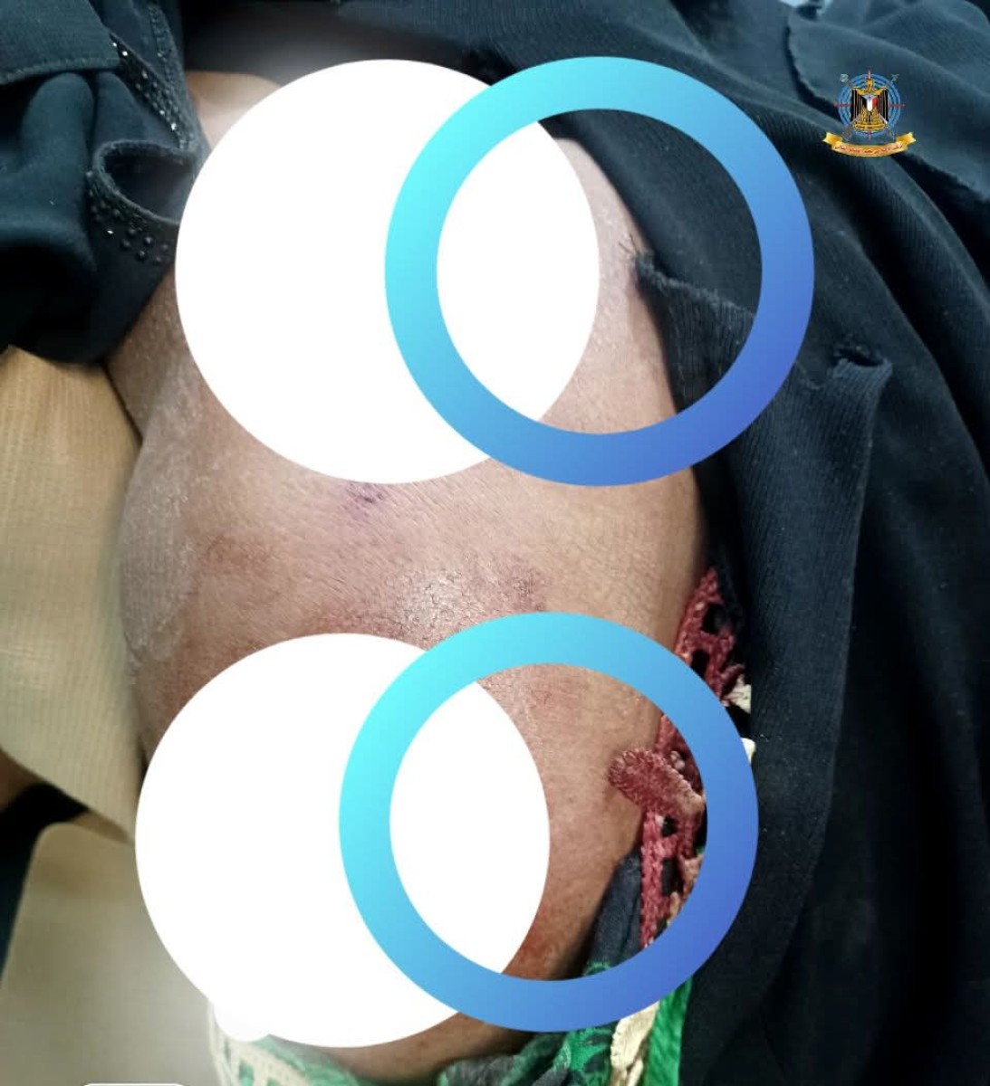 إصابة امرأة برصاصة قناص حوثي شمال غربي الضالع